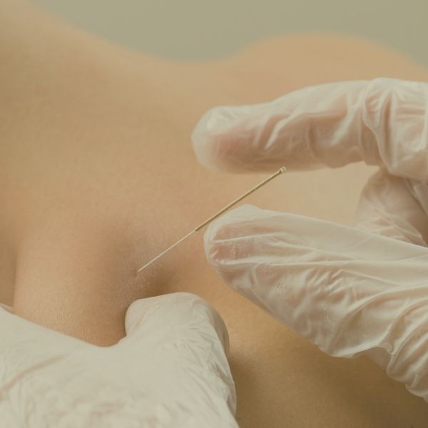 Dry Needling Berlin